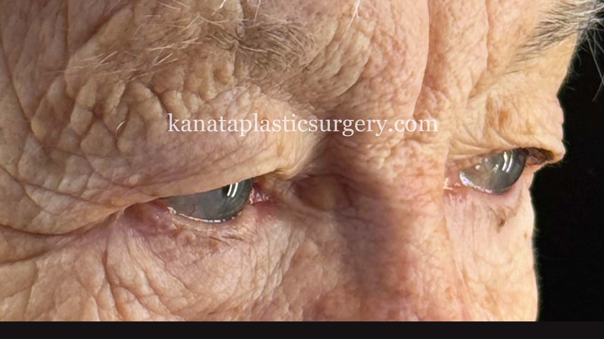 eyelid lift eye blepharoplasty before and after ottawa 1