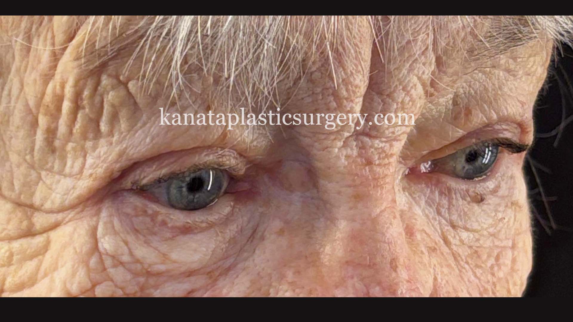 eyelid lift eye blepharoplasty before and after ottawa 2