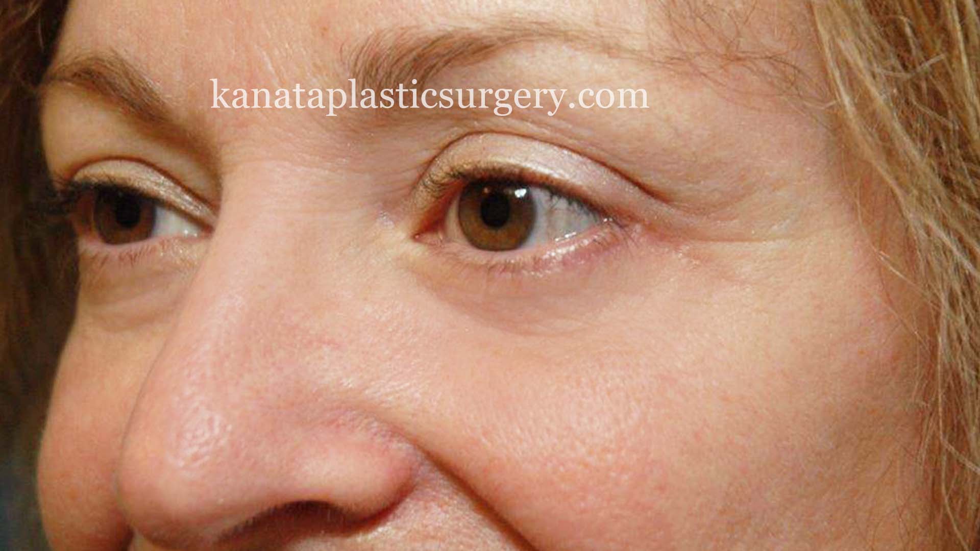 eyelid lift surgery blepharoplasty after 2