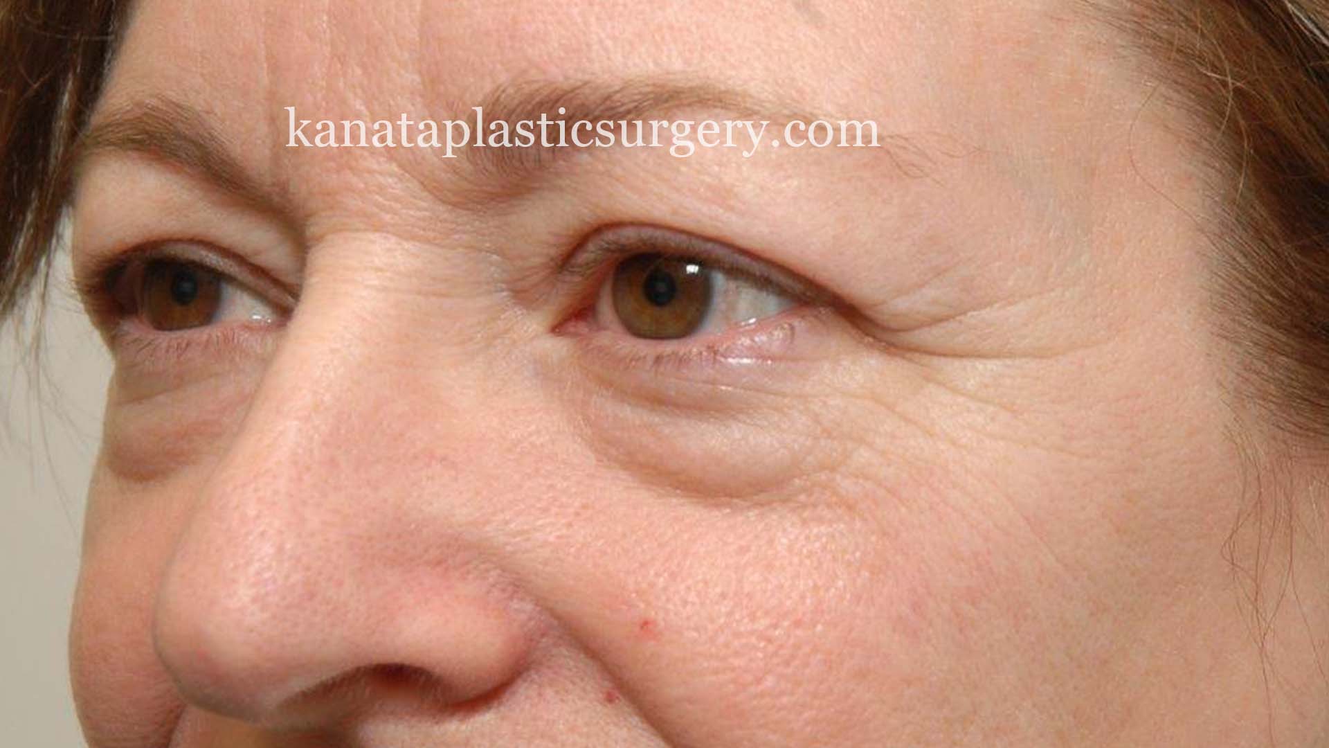 eyelid lift surgery blepharoplasty before 1