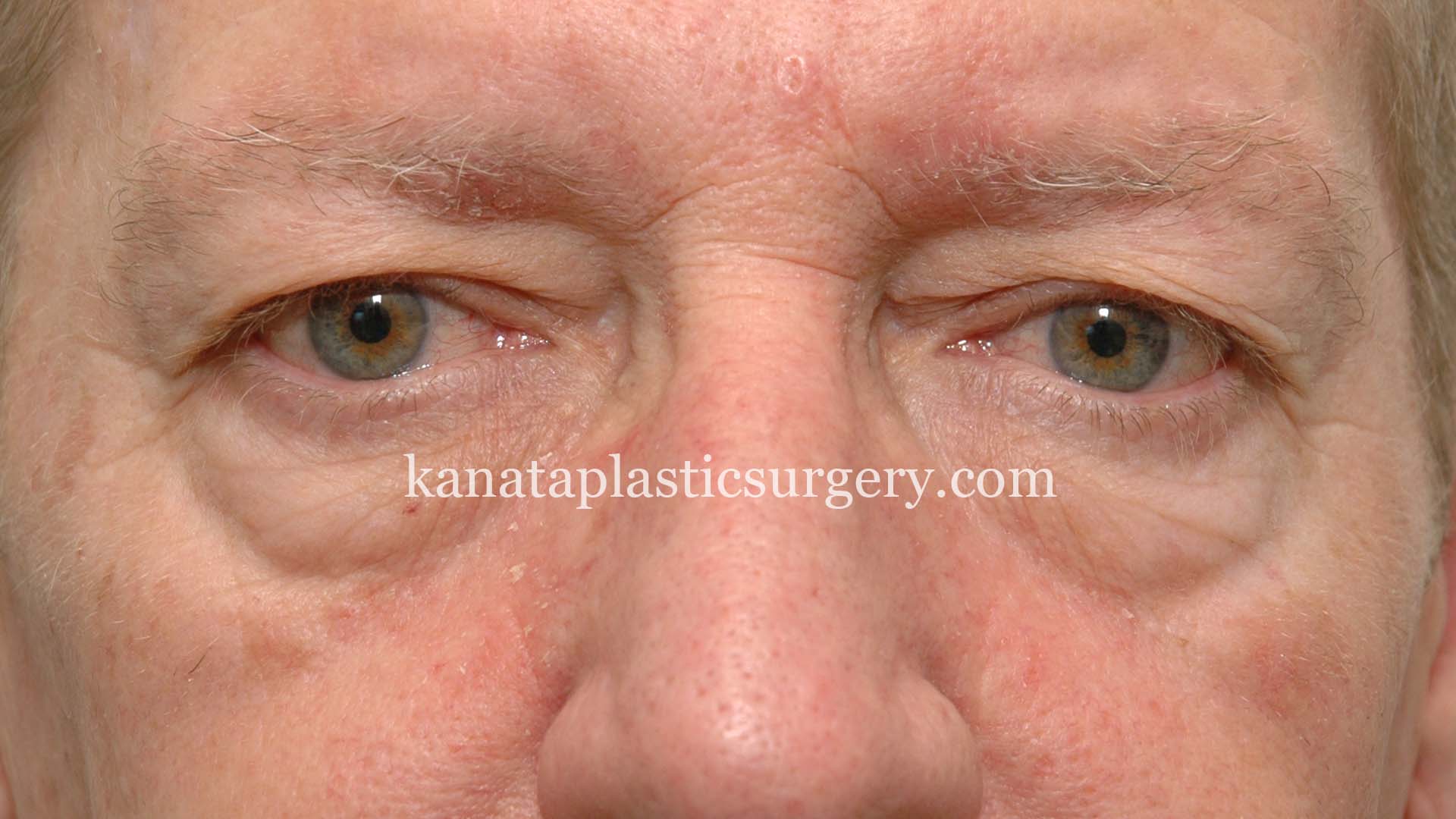 eyelid lift surgery blepharoplasty before after 1 (1)