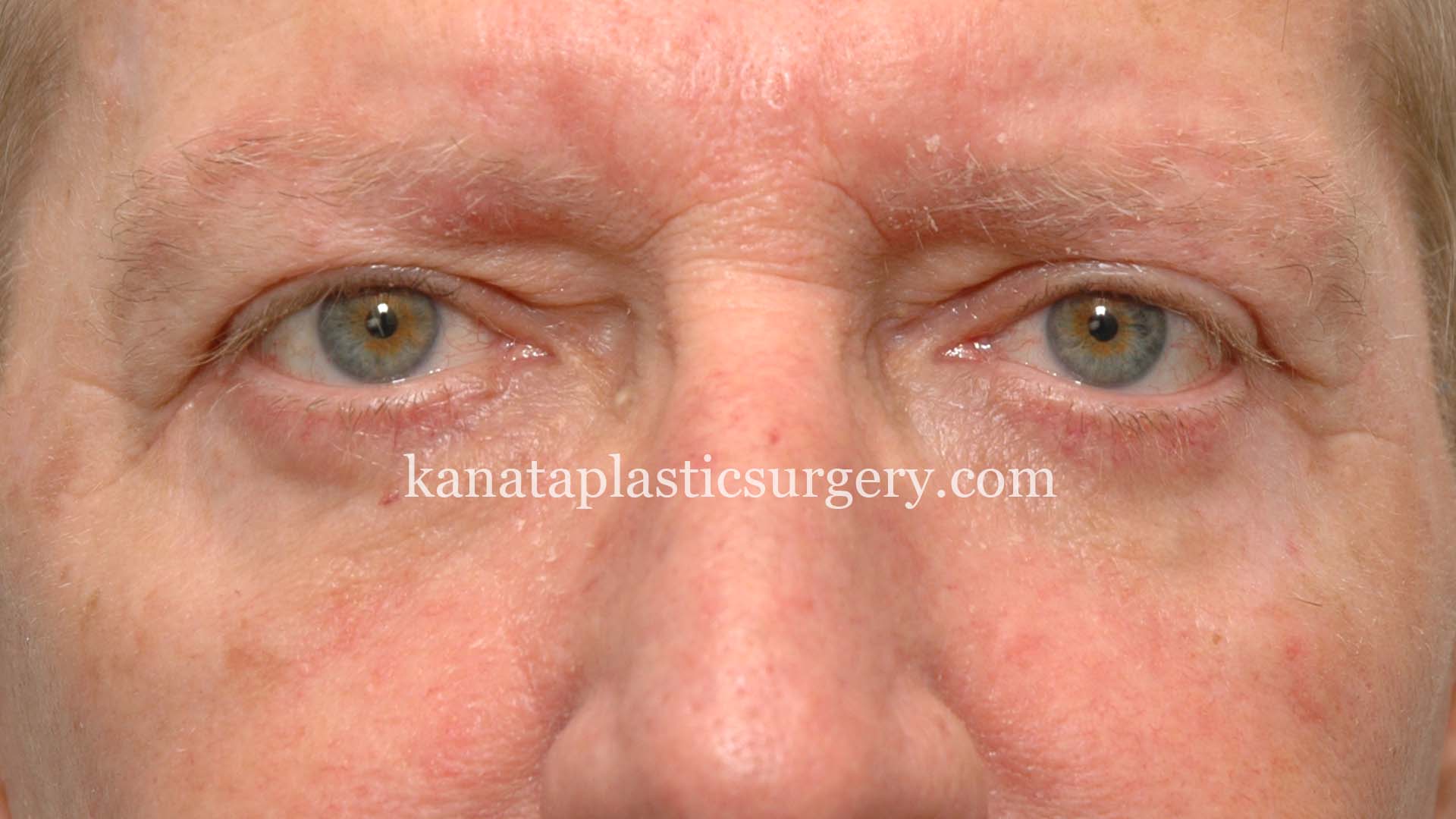 eyelid lift surgery blepharoplasty before after 2