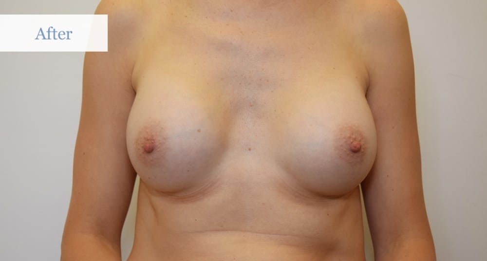 Ottawa Breast Augmentation