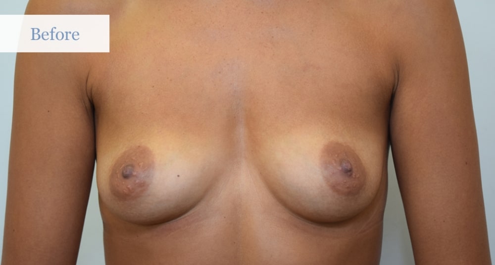 Before breast augmentation photos