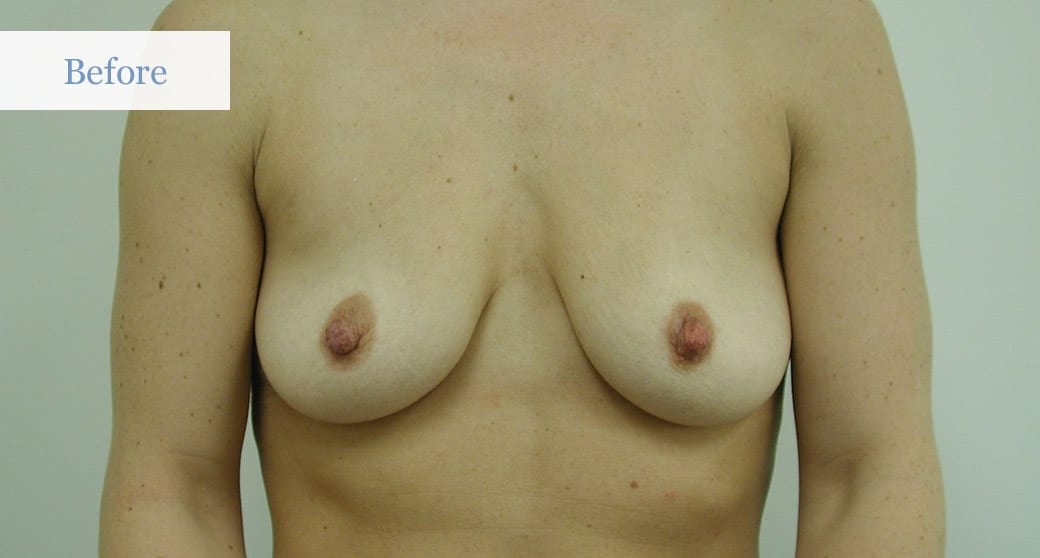 Ottawa Breast Lift - Before and After