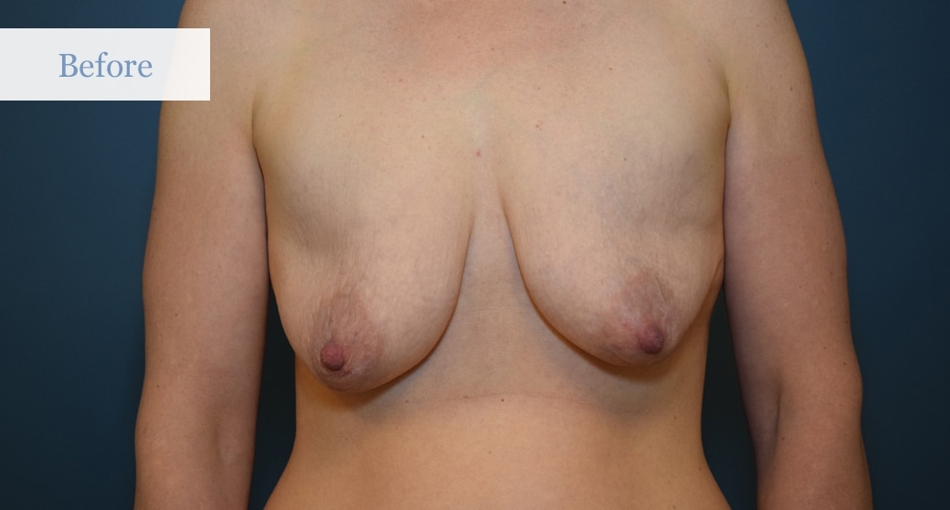 Ottawa Breast Lift - Before and After