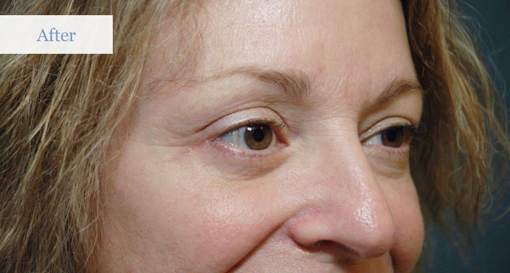 Ottawa Eyelid Surgery - Eye Lift - Before and After