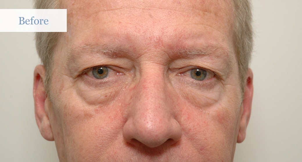 Ottawa Eyelid Surgery - Eye Lift - Before and After