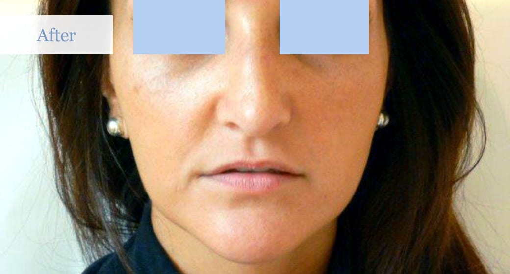 Ottawa Nose Job - Rhinoplasty Surgery - Before and After