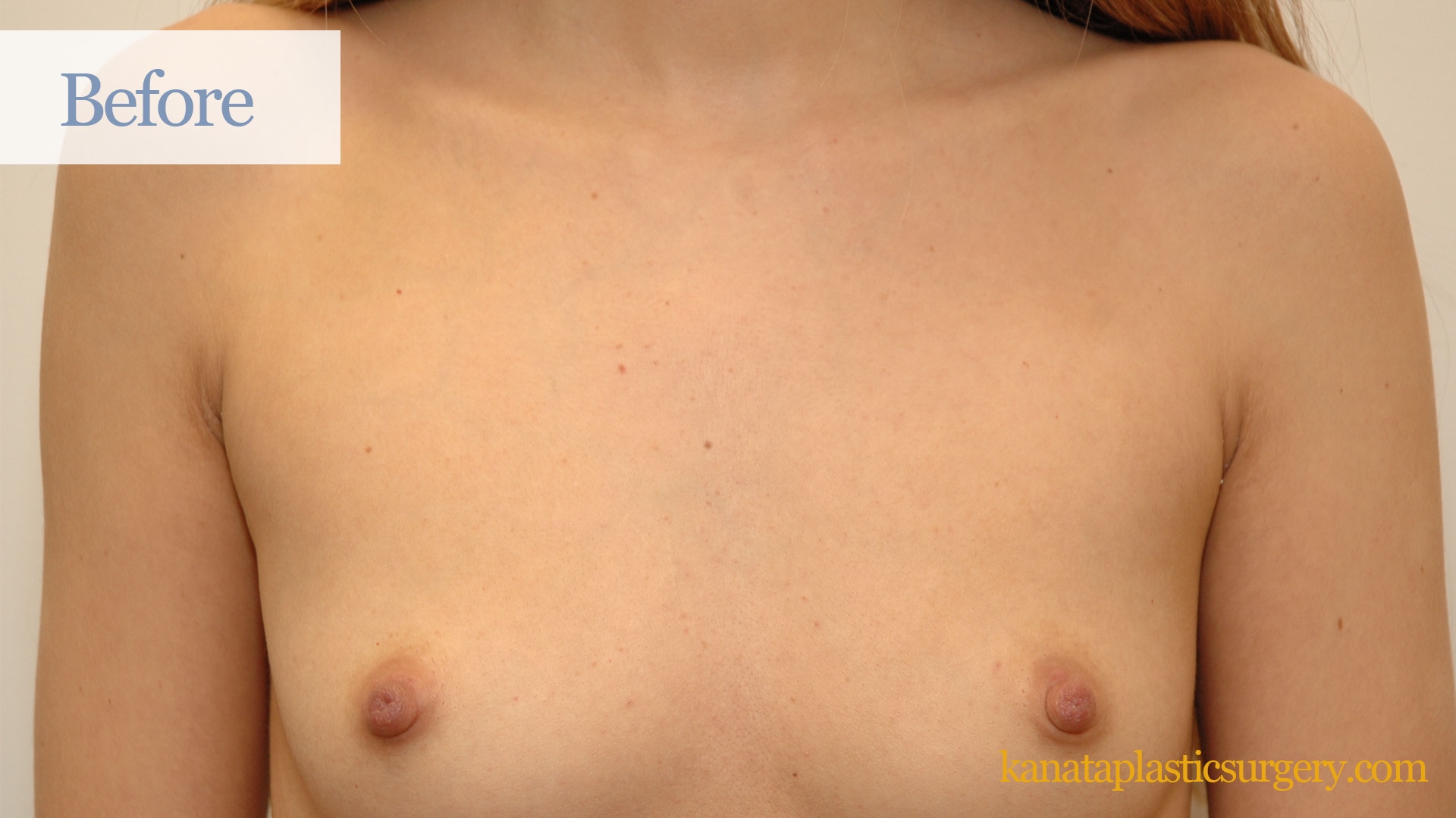 breast -augmentation-ottawa-boob-job-cosmetic-kanata-before-plastic-surgery-sergical- 34 - Kanata Plastic and Cosmetic Surgery