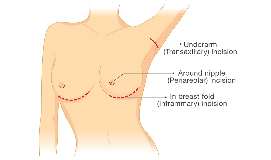breast incisions