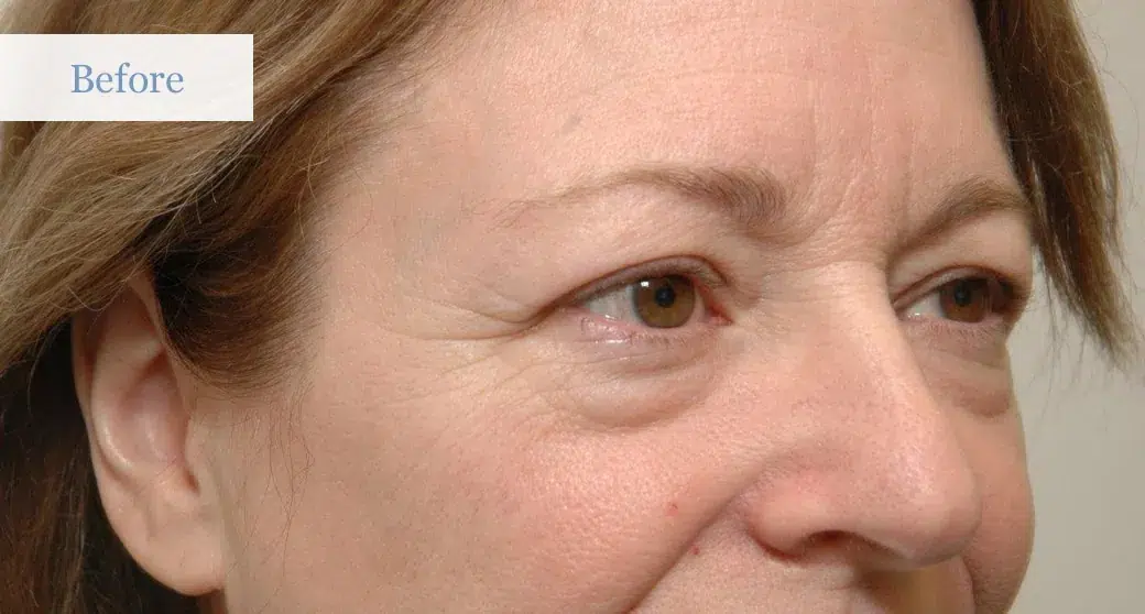 Ottawa Eyelid Surgery Eye Lift Before and After 1
