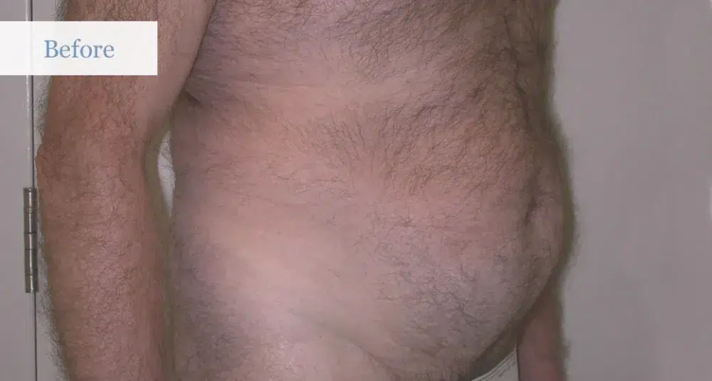 Ottawa Liposuction Surgery Before and After 1