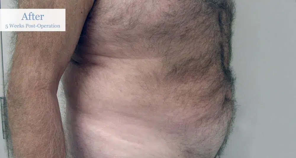 Ottawa Liposuction Surgery Before and After 2