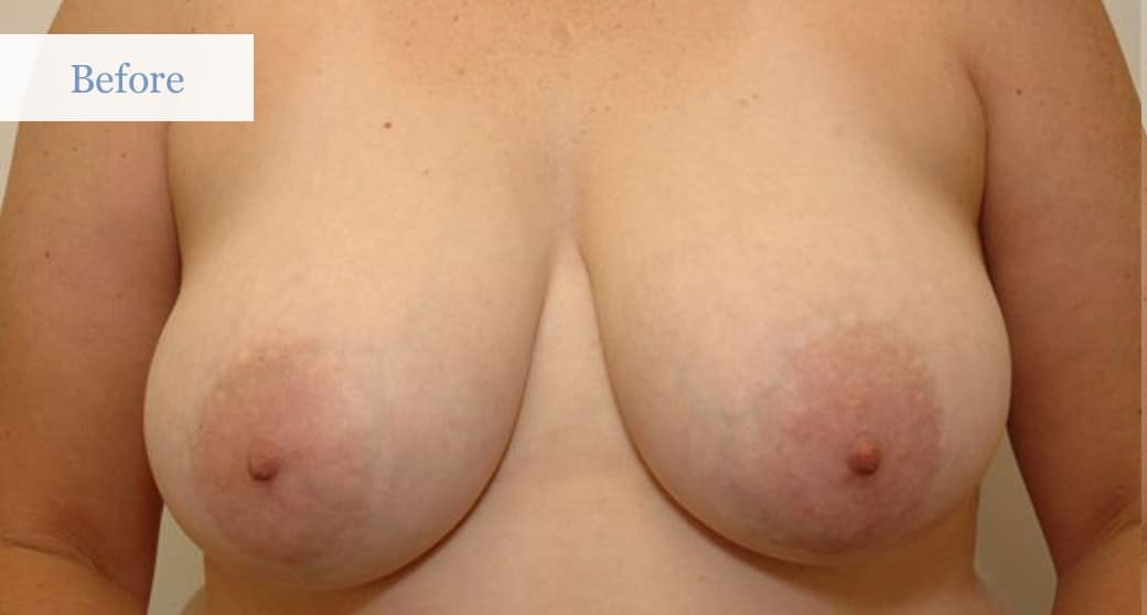 Ottawa Breast Reduction Before and After 1 (1)