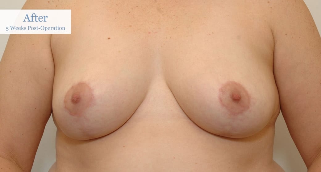 Ottawa Breast Reduction Before and After 2 (1)