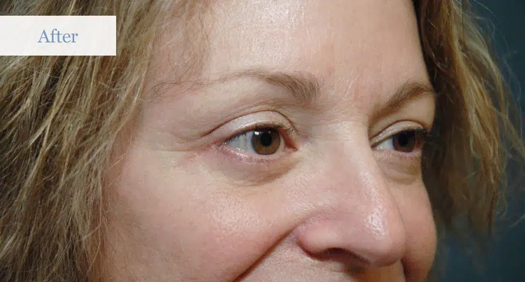 Ottawa Eyelid Surgery Eye Lift Before and After 2