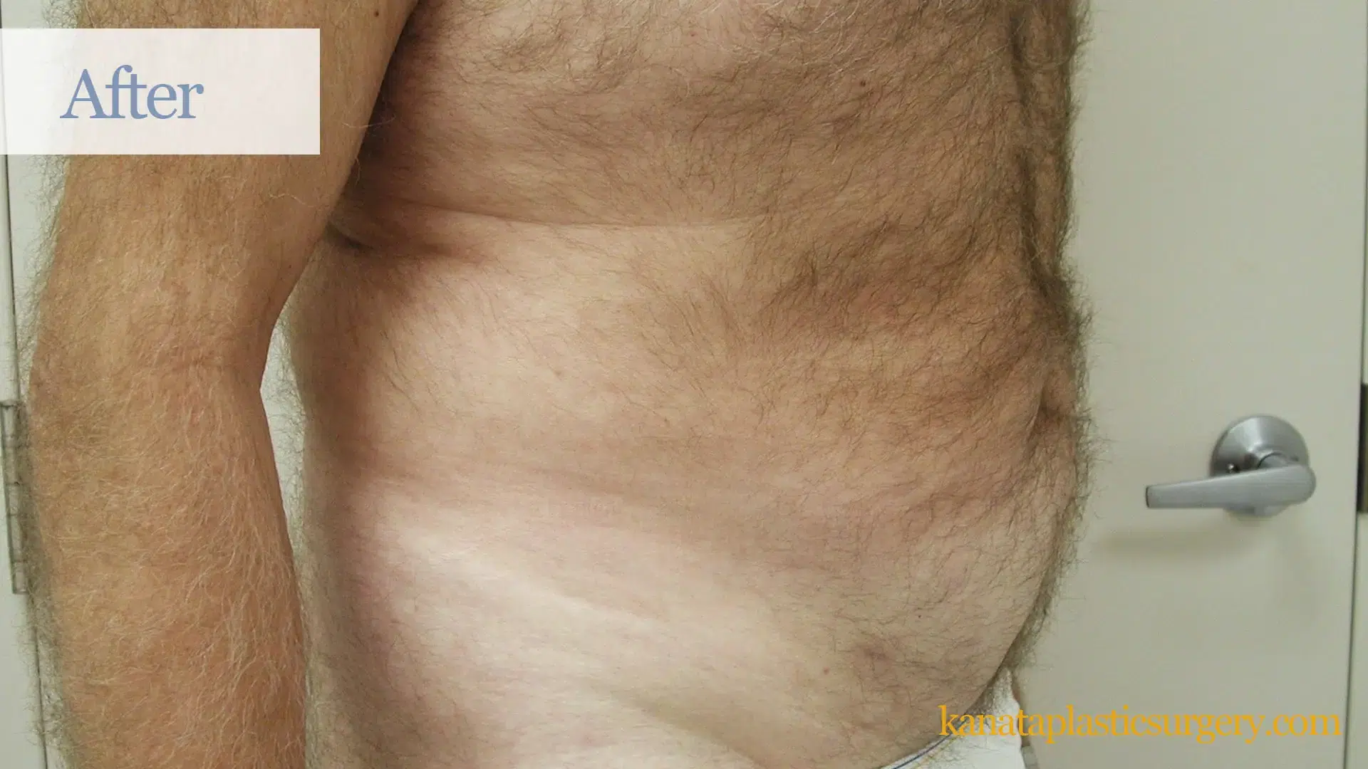 plastic surgery sergical after liposuction ottawa cosmetic kanata WK
