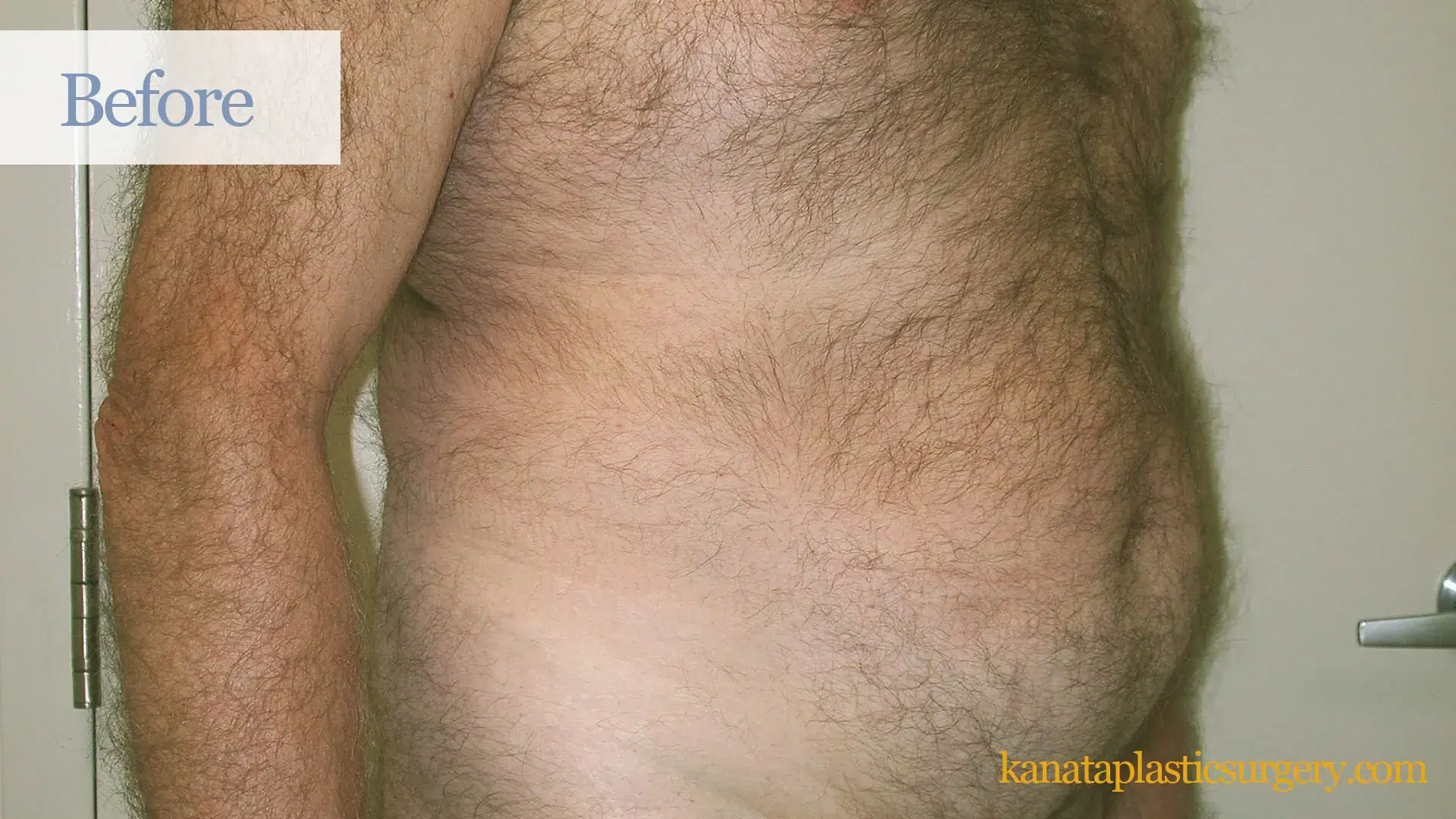 plastic surgery sergical before liposuction ottawa cosmetic kanata WK