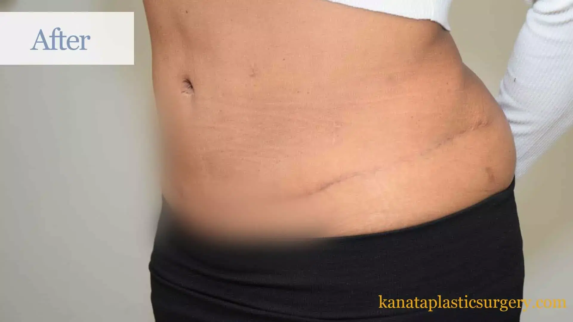 plastic cosmetic surgery fat loss liposuction after