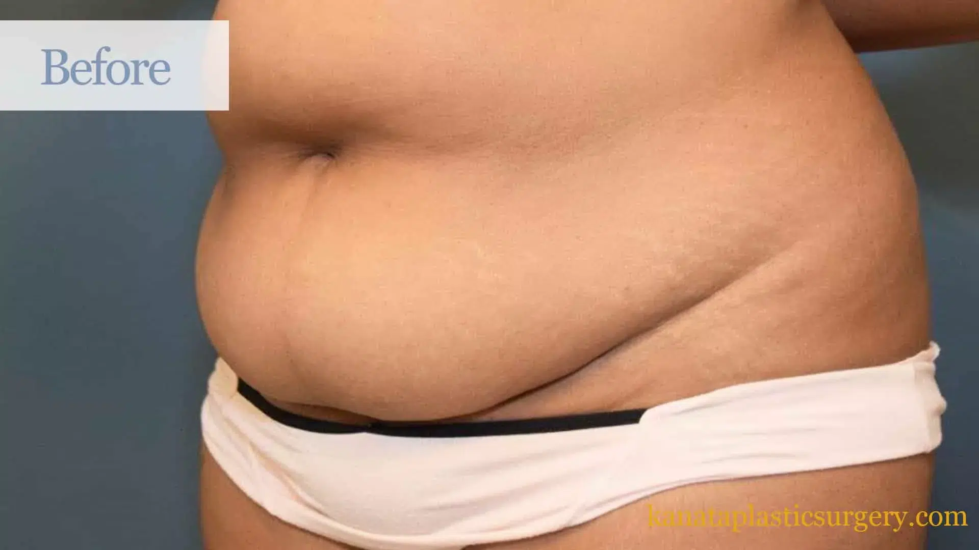 plastic cosmetic surgery fat loss liposuction before
