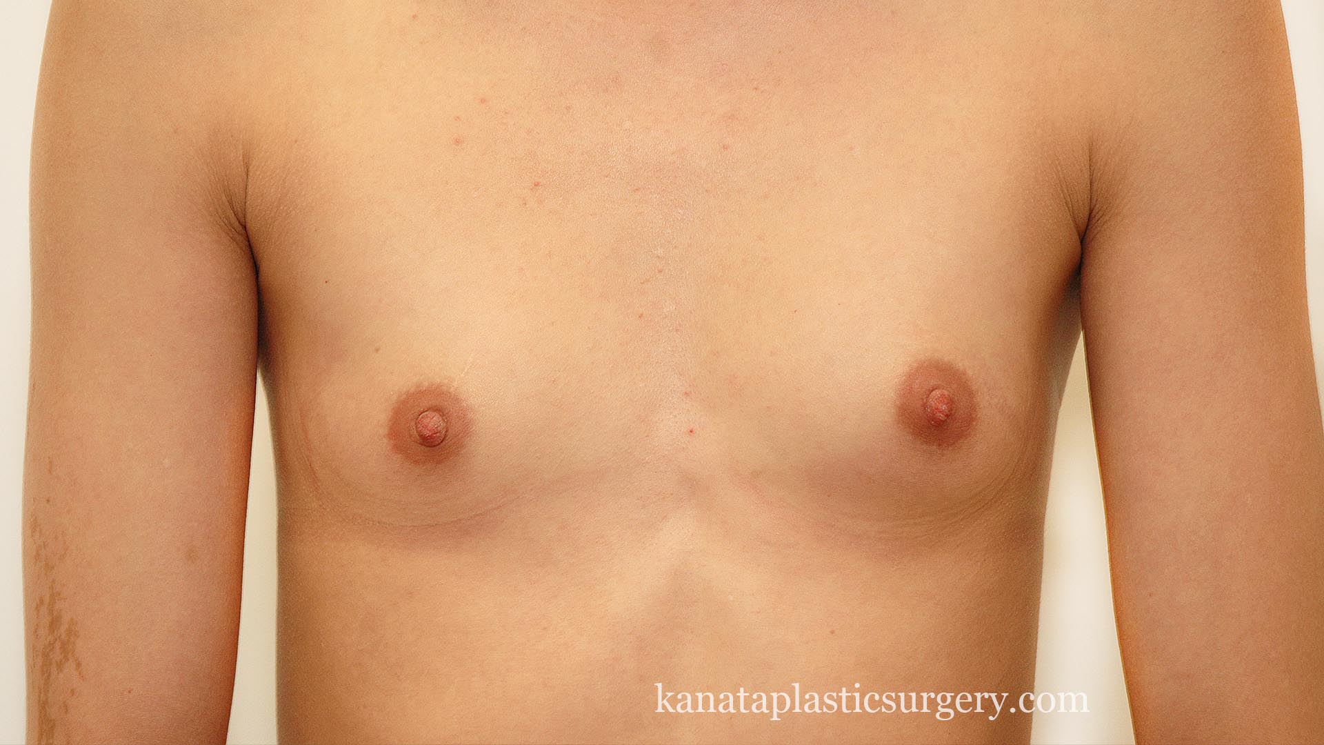 64 breast implants before photos