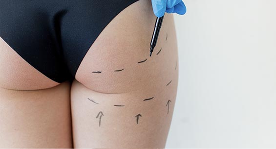 bbl brazillian butt lift ottawa before and after photos