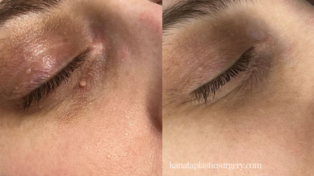 ottawa freeze pen before and after