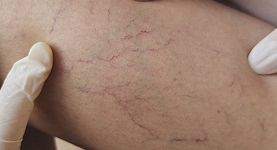 vein reduction ottawa
