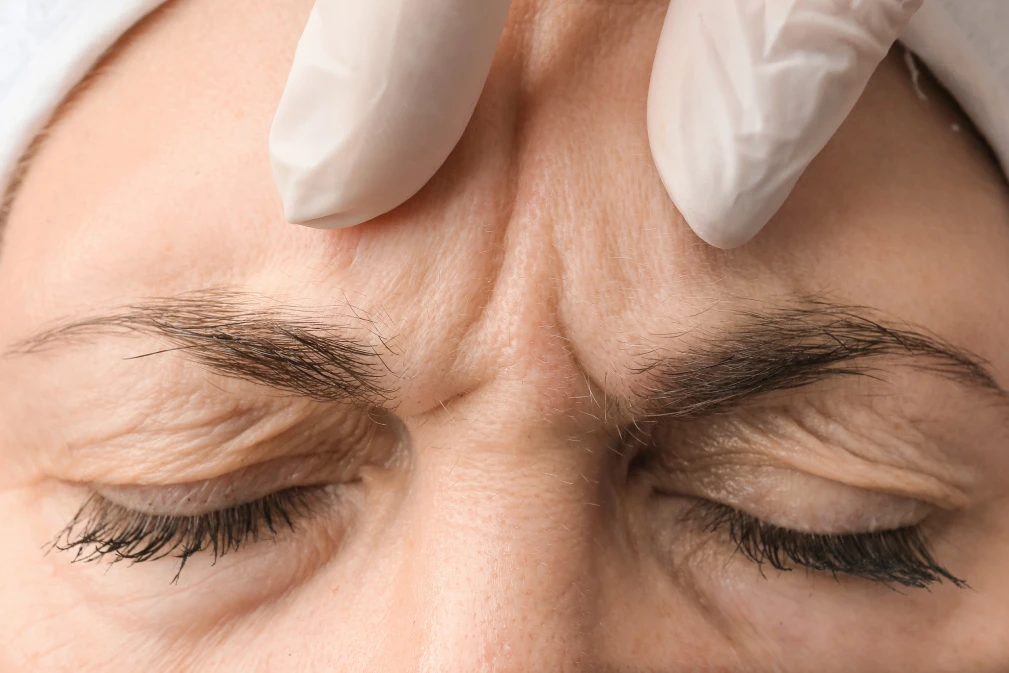 botox kanata stittsville