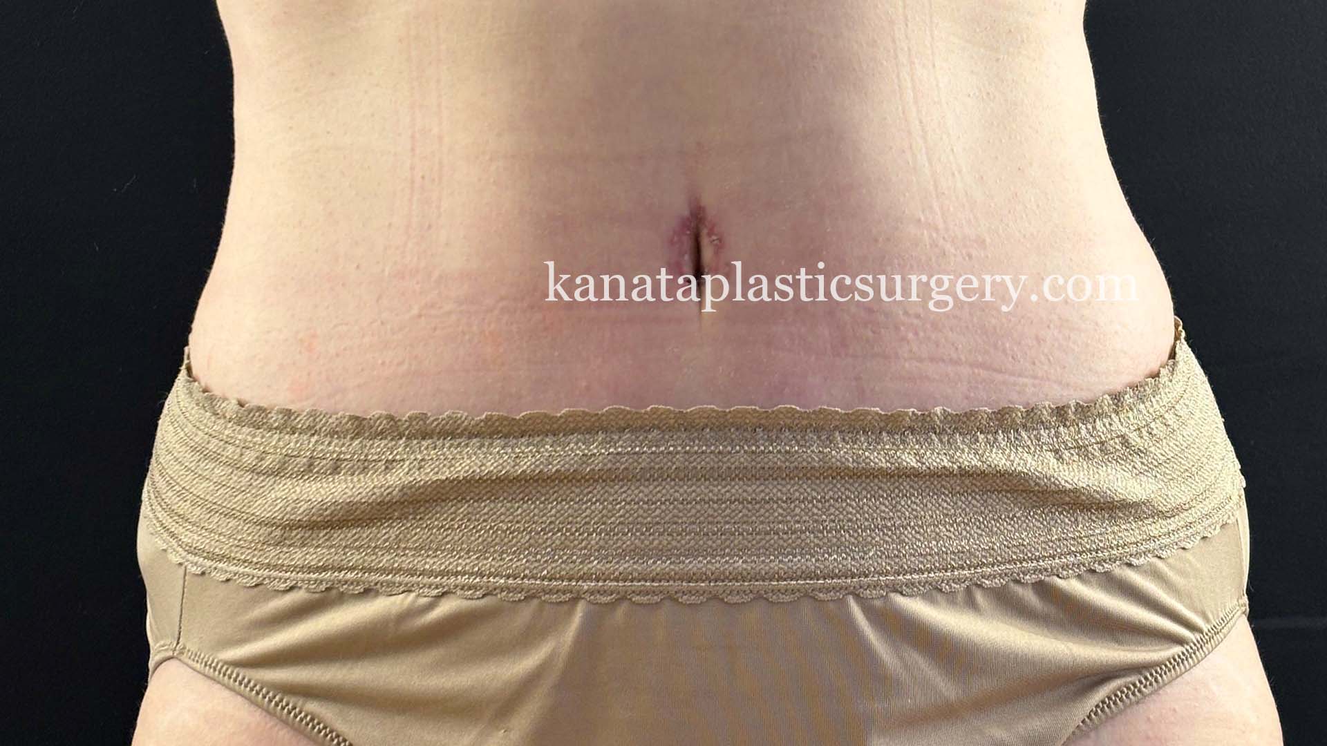 Abdominoplasty after 1