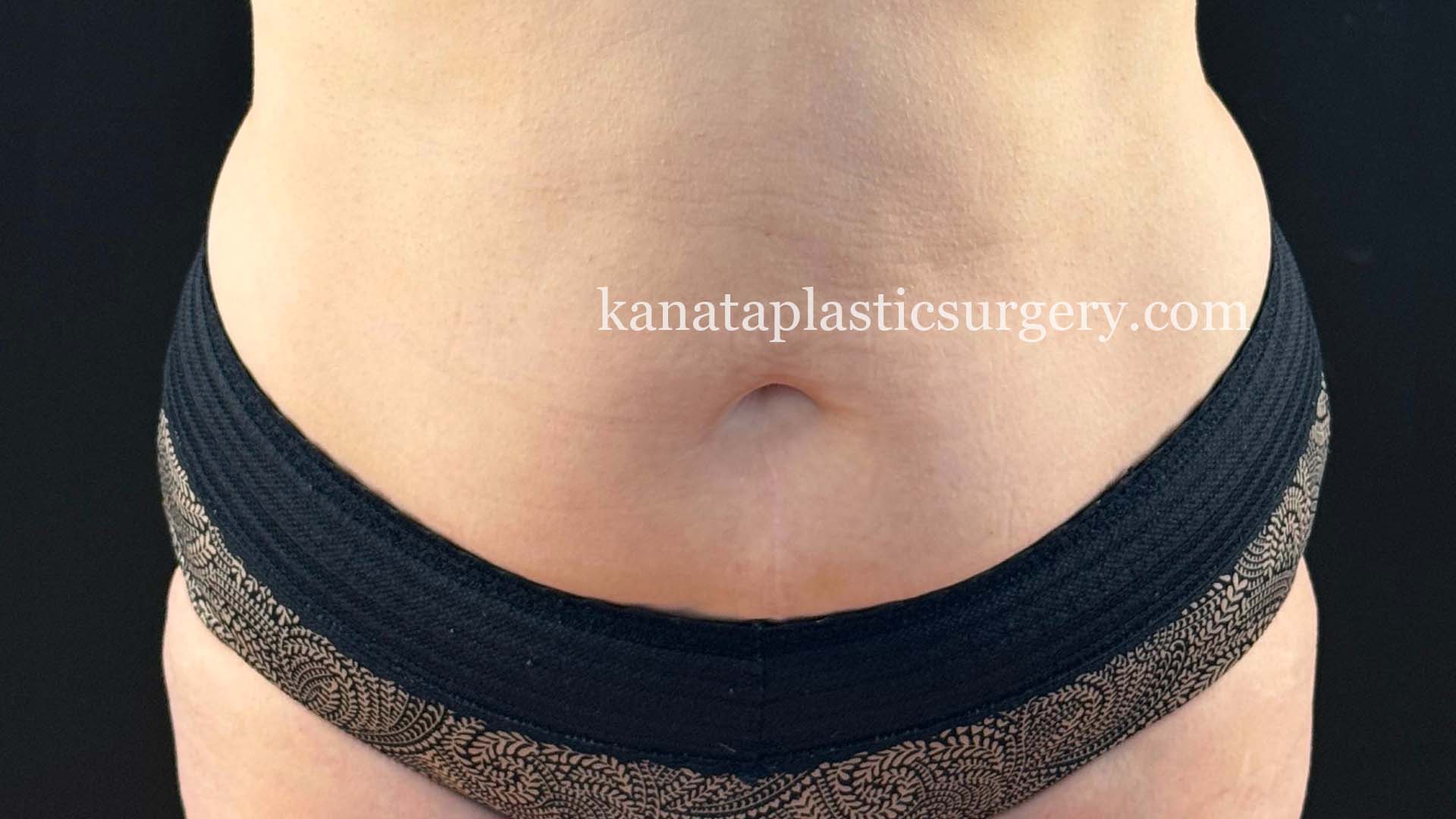 Abdominoplasty before 1