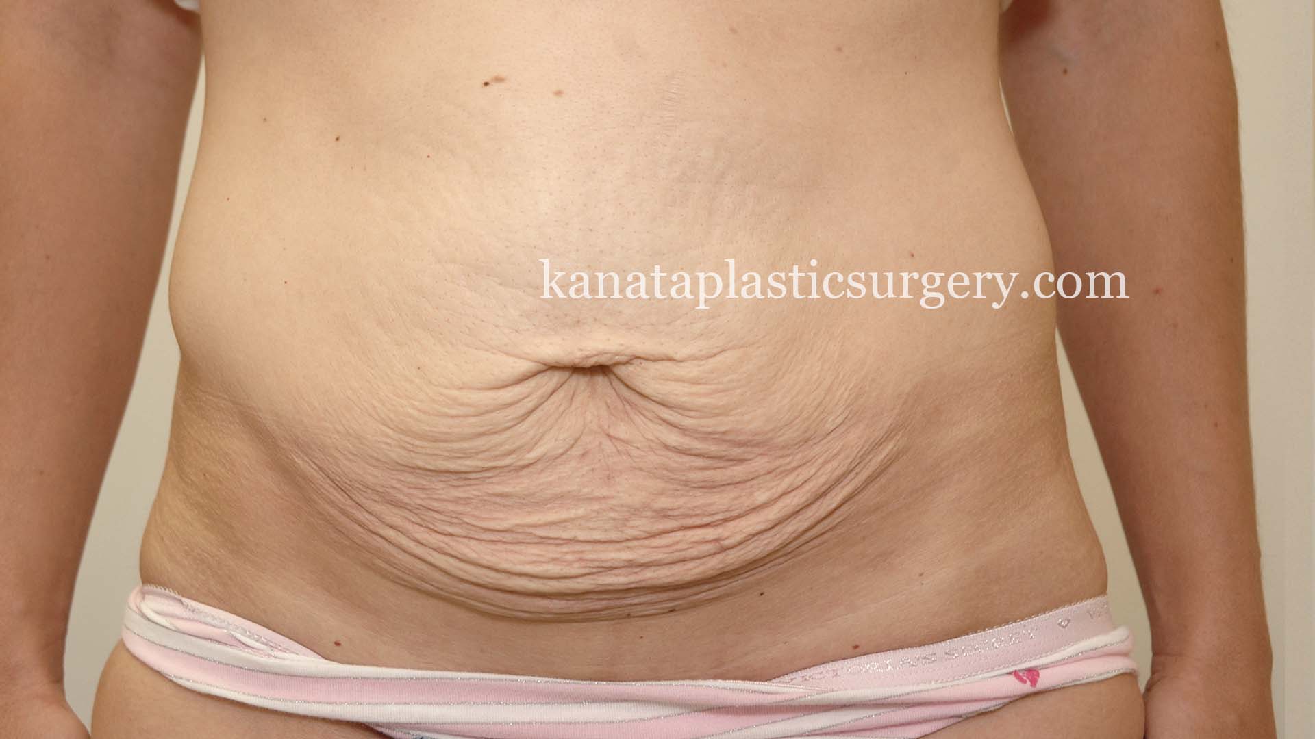 Abdominoplasty before after 1