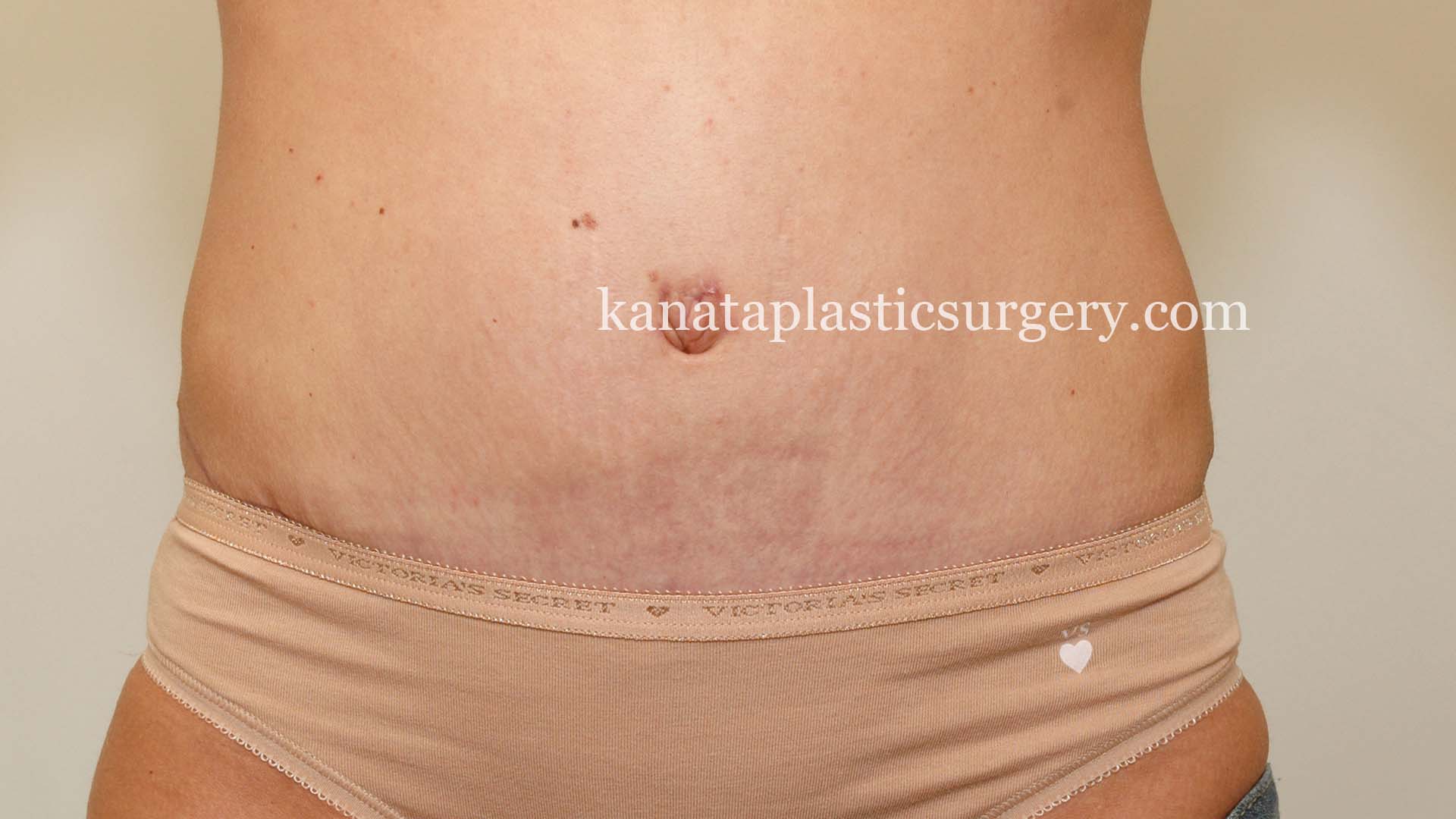 Abdominoplasty before after 2