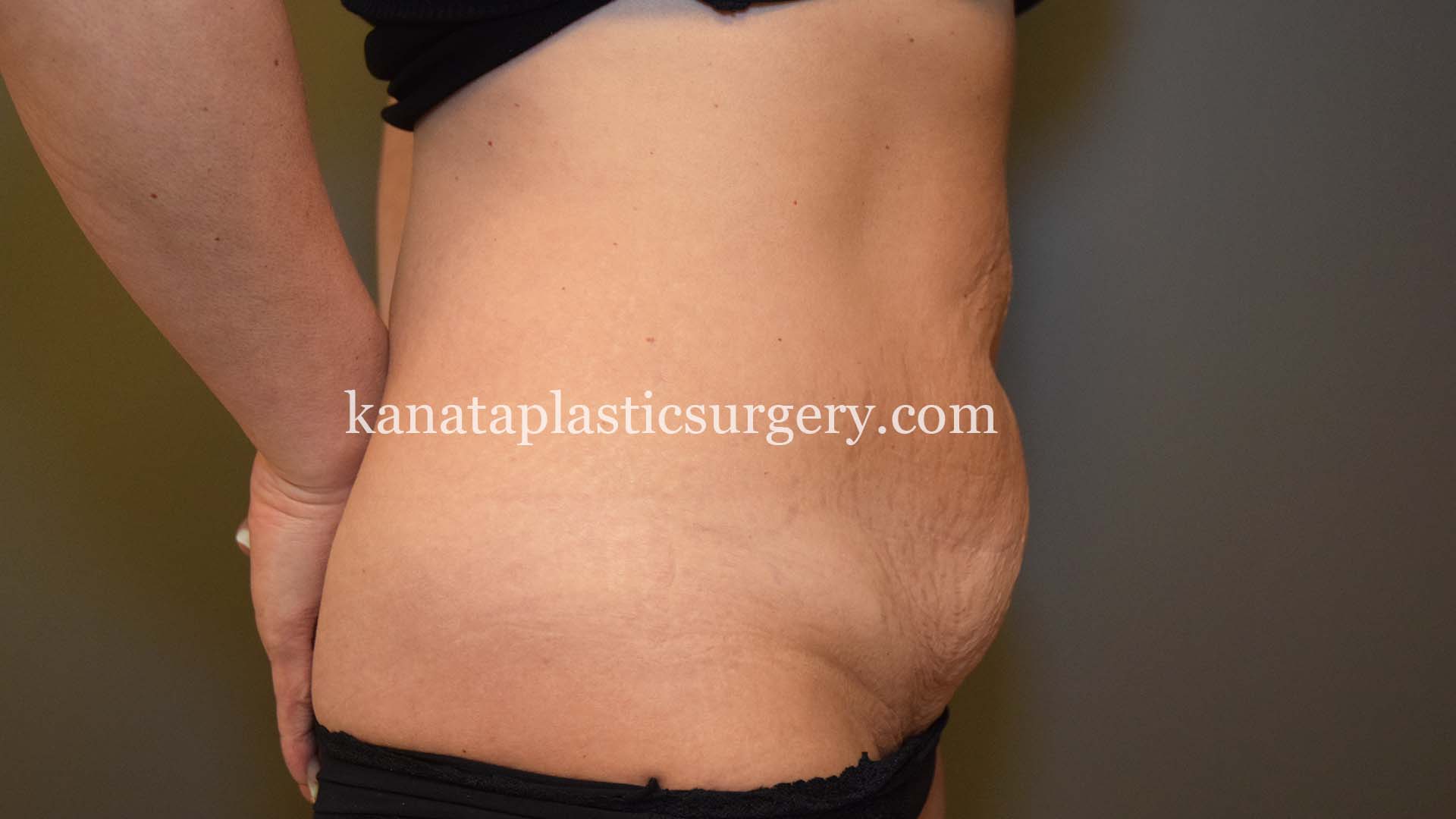 Abdominoplasty before and after 1