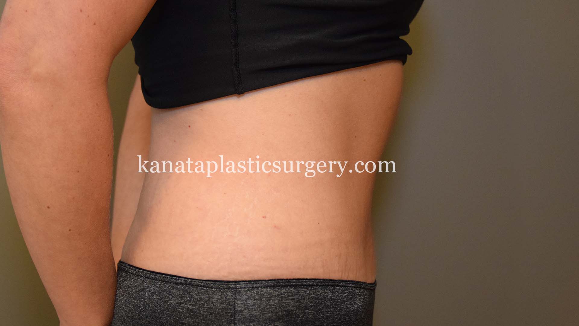 Abdominoplasty before and after 2