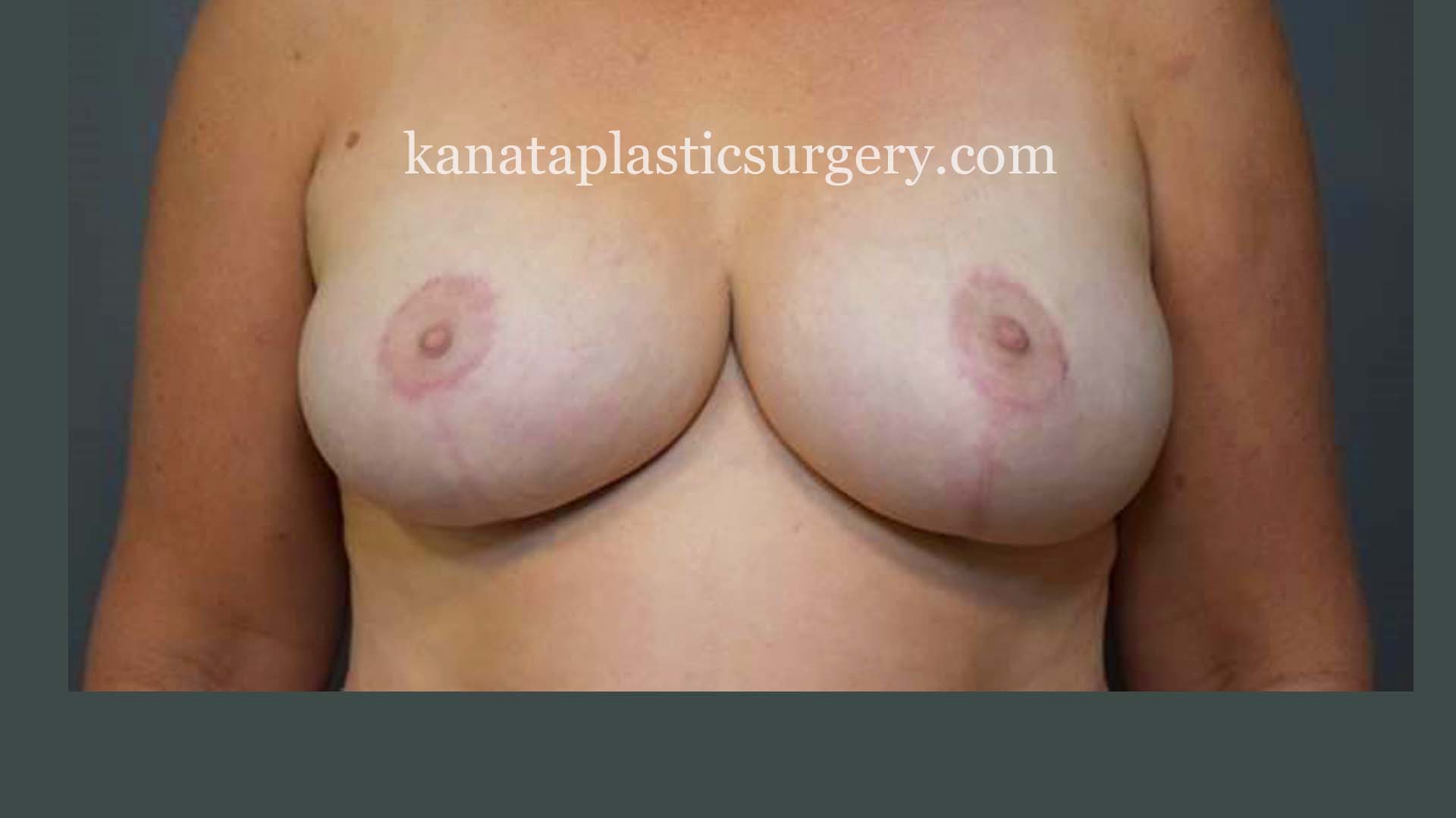 Breast reduction ottawa before after 2