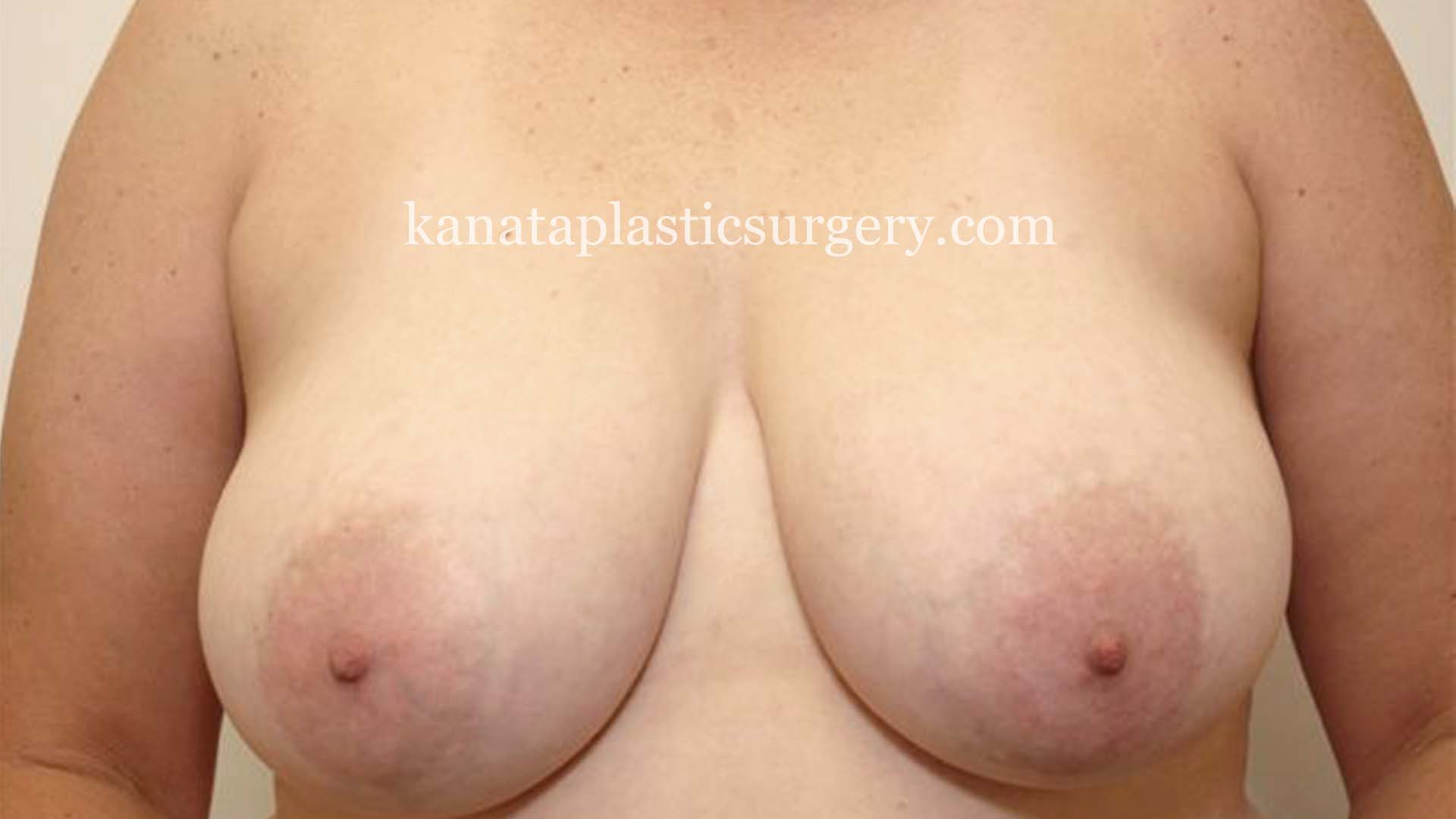 Breast reduction ottawa before after pic 1