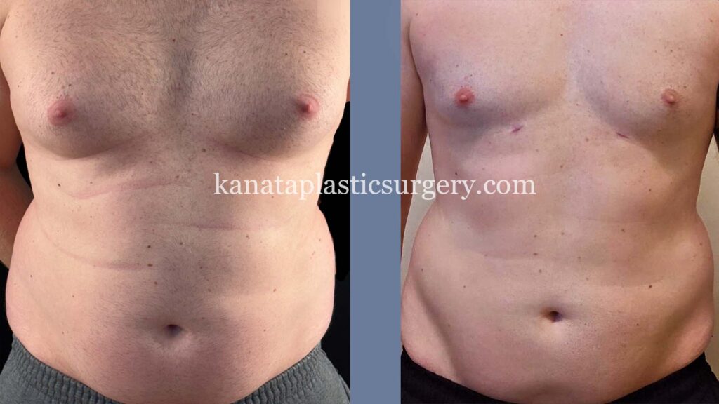 Male breast reduction gynocomastia before and after photos ottawa