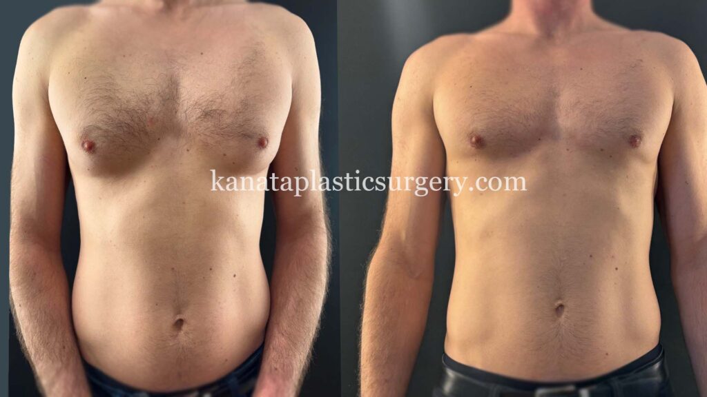 Male breast reduction gynocomastia before and after photos plastic surgery