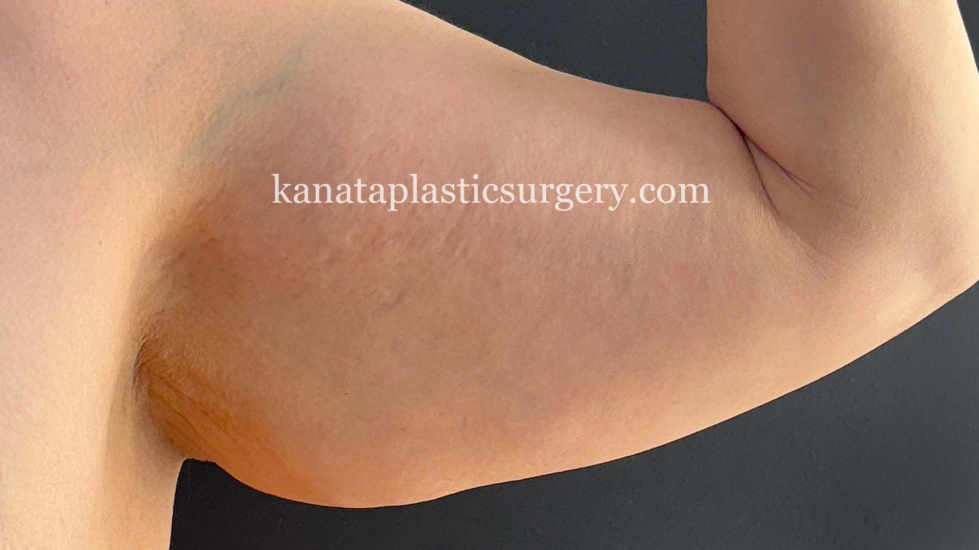 arm lift brachioplasty before after 1