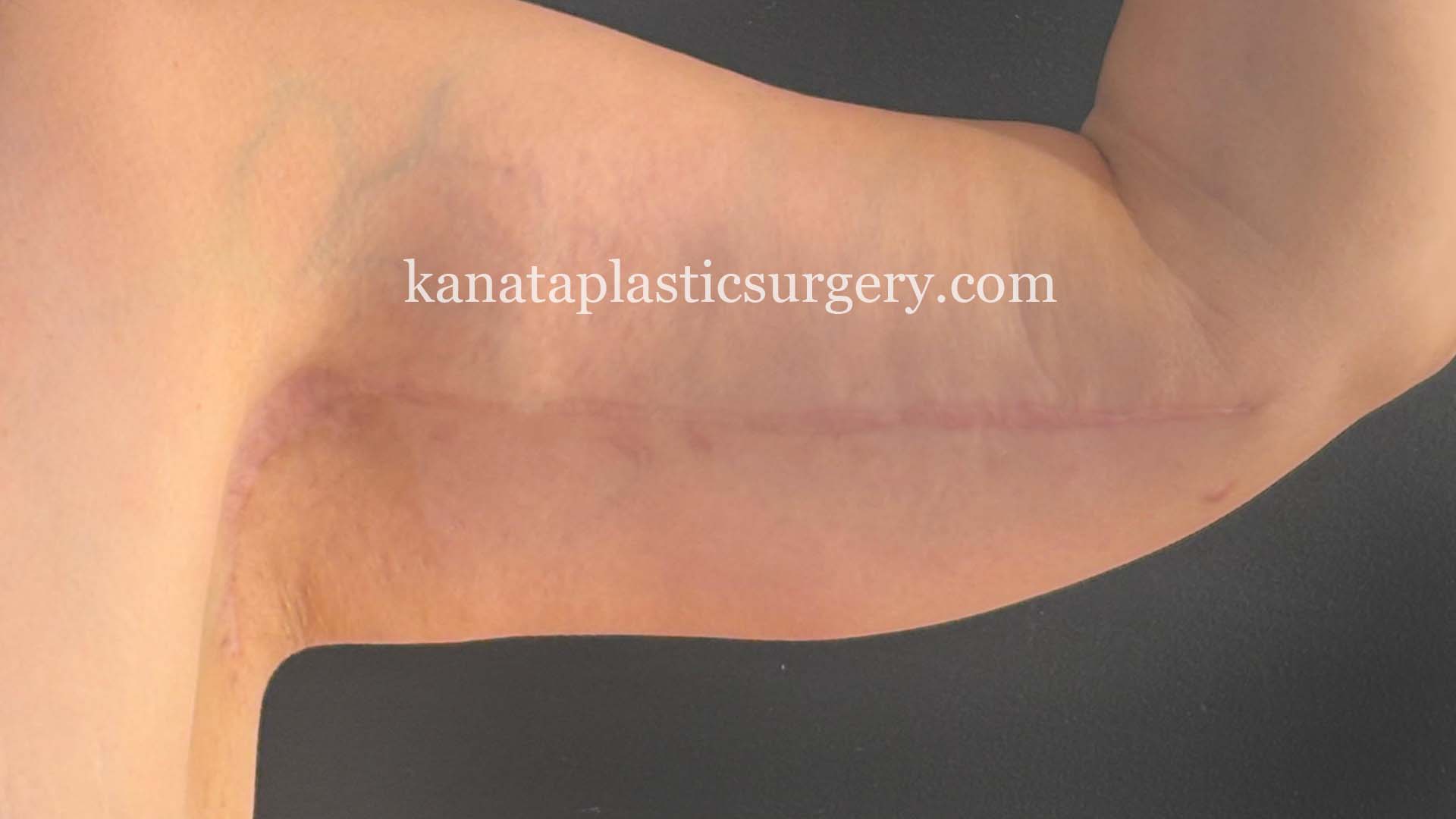 arm lift brachioplasty before after 2