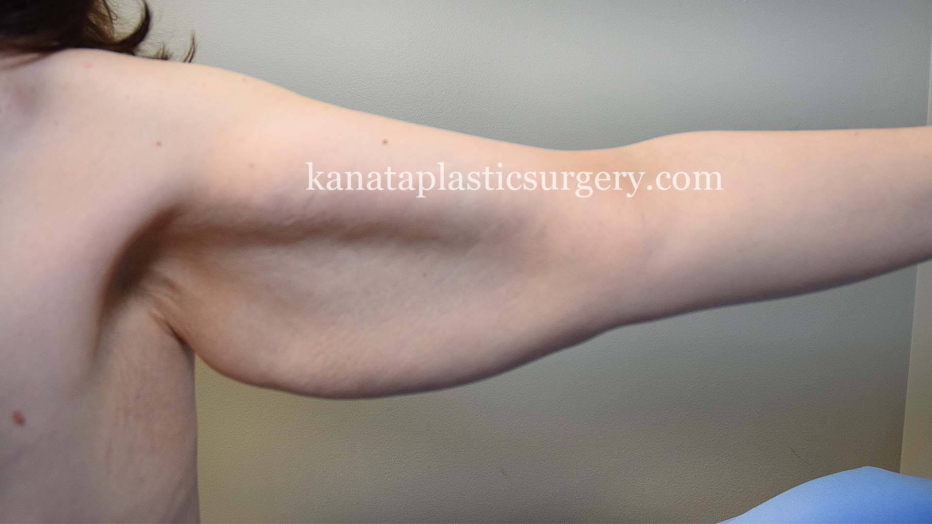 arm lift brachioplasty before and after 1