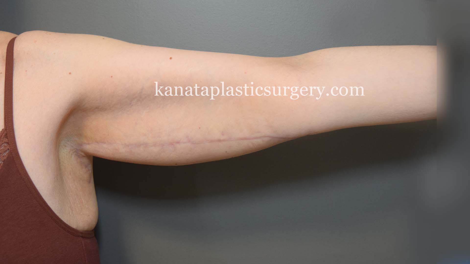 arm lift brachioplasty before and after 2