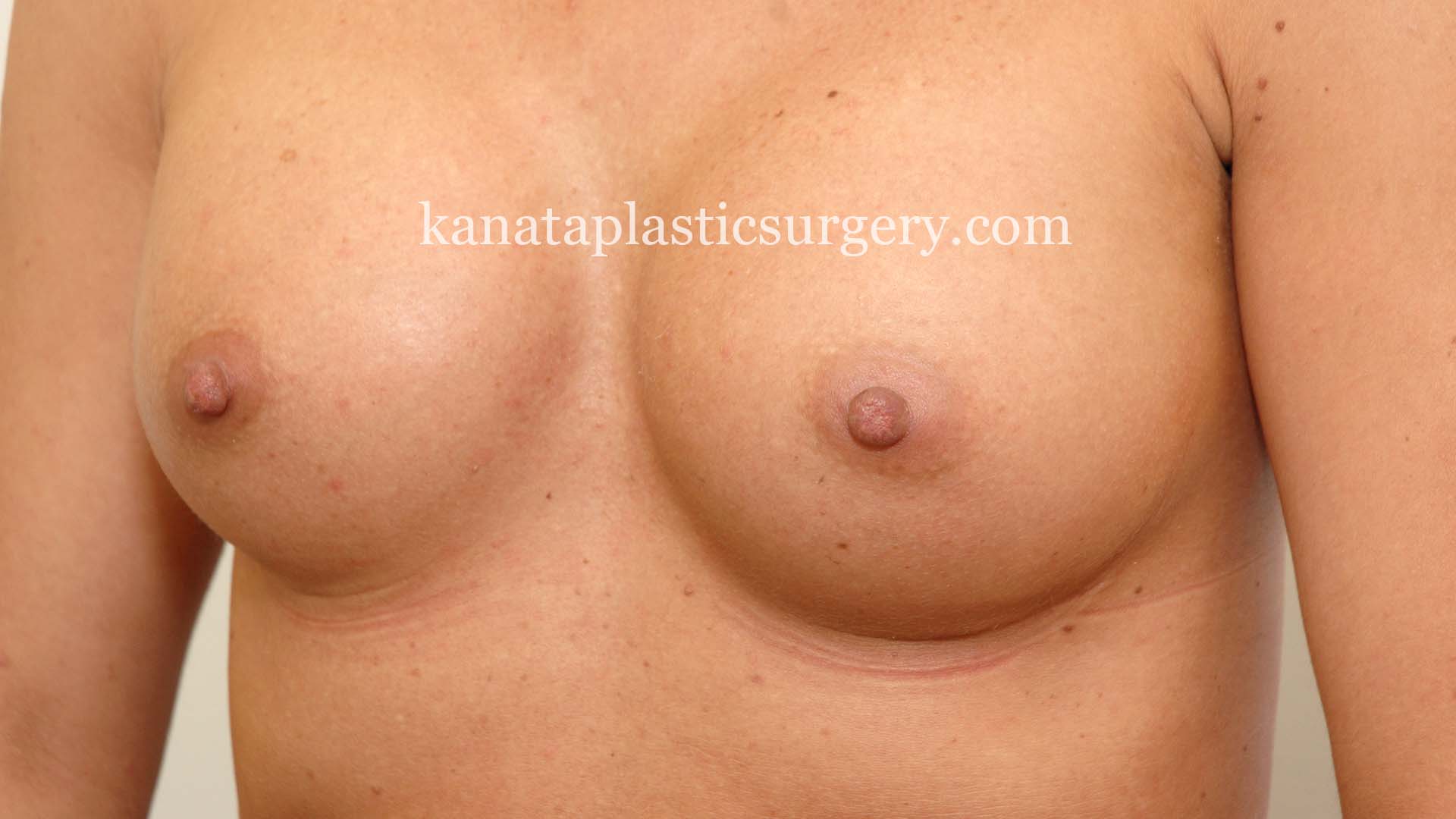 breast augmentation before and after 1