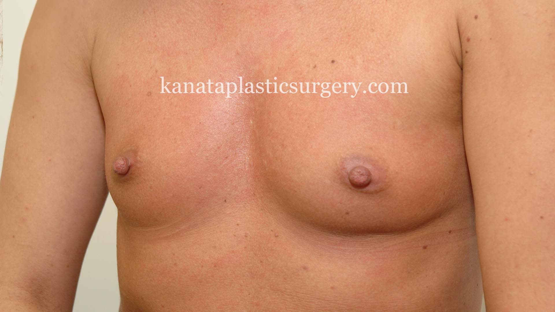 breast augmentation before and after 2