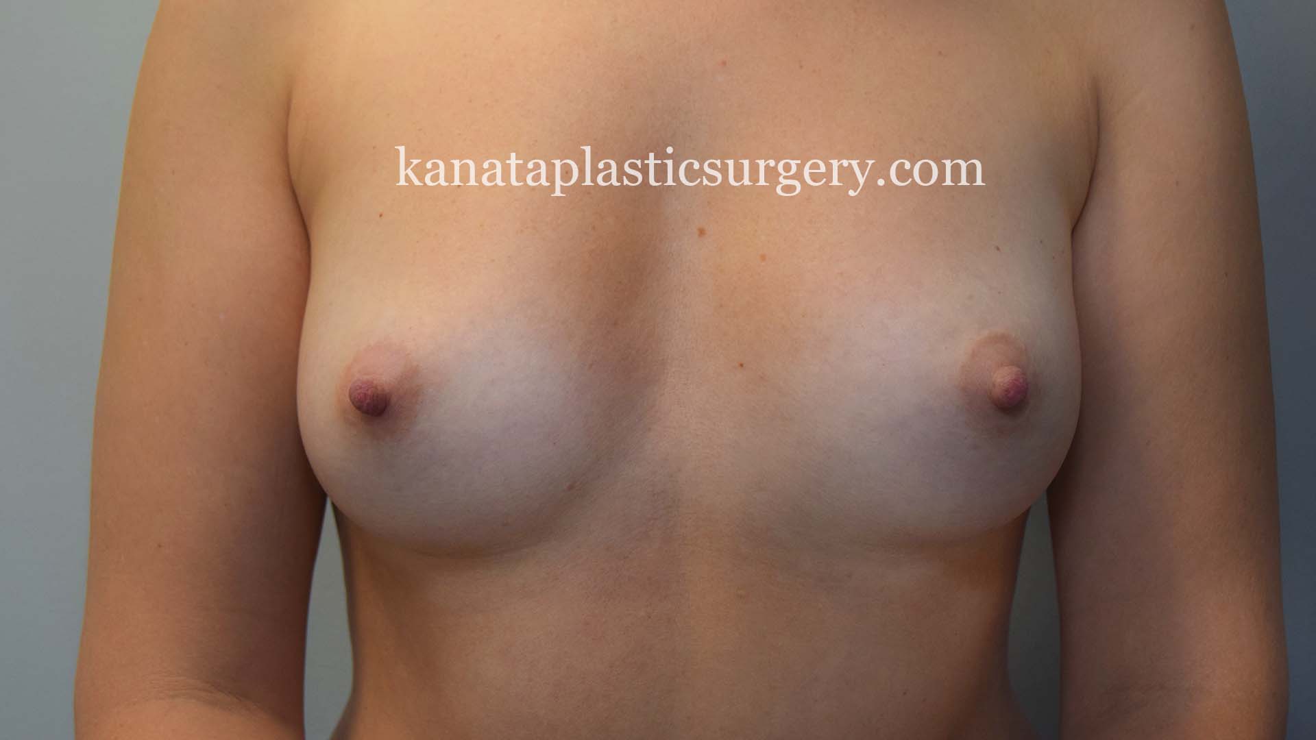 breast implant exchange removal before after 1