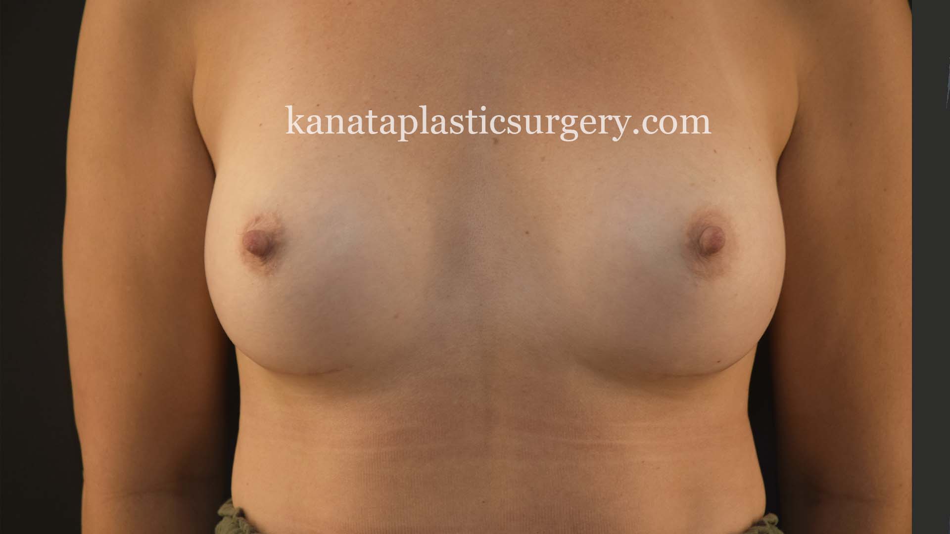 breast implant exchange removal before after 2