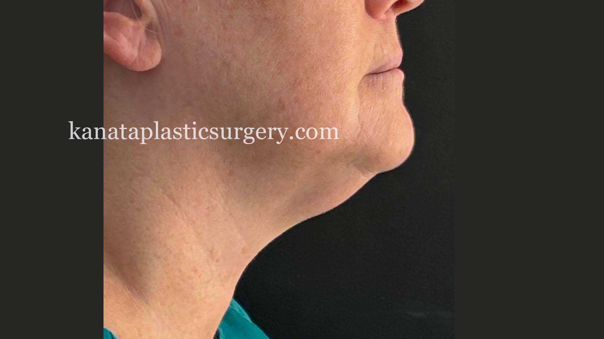 chin Liposuction ottawa before after 1