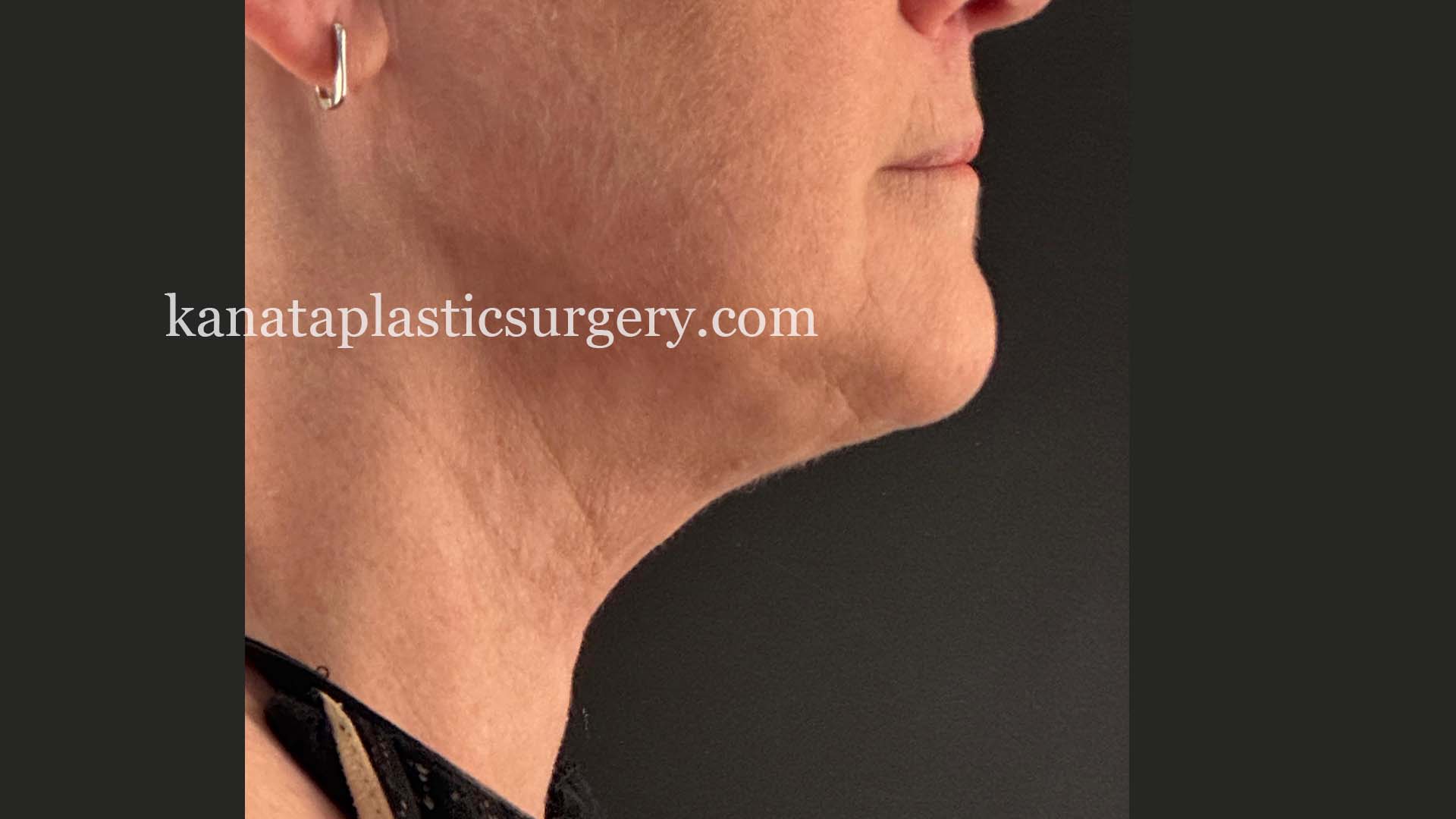 chin Liposuction ottawa before after 2